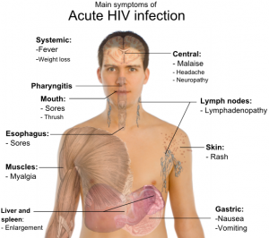 Symptoms of acute HIV infection.