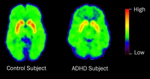 The brain of someone without ADHD compared to someone with ADHD.  